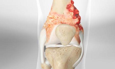 Sarcoma Symptoms, Types, Causes, and Treatments