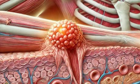 Sarcoma Symptoms, Types, Causes, and Treatments