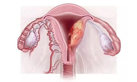 Sarcoma Symptoms, Types, Causes, and Treatments