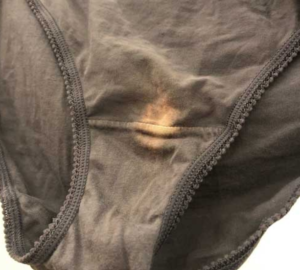 If you find a “bleach” patch on your underwear, here’s what it means