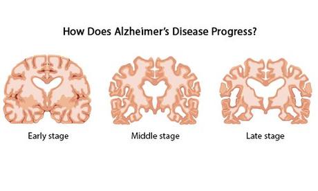 What is Alzheimer’s Disease?- Causes, Symptoms, Prevention