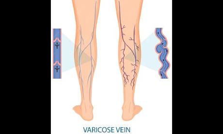 How to Get Rid of Varicose Veins