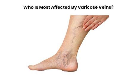 How to Get Rid of Varicose Veins