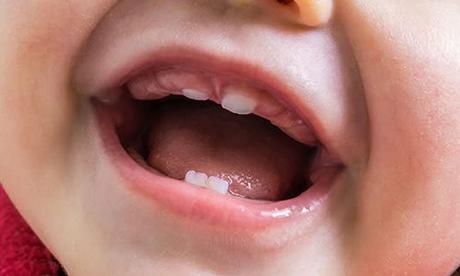 What Causes Lip Ties in Babies and How to Treat Them?