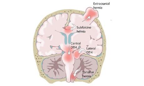 Brain Herniation: Types, Symptoms, and Treatment