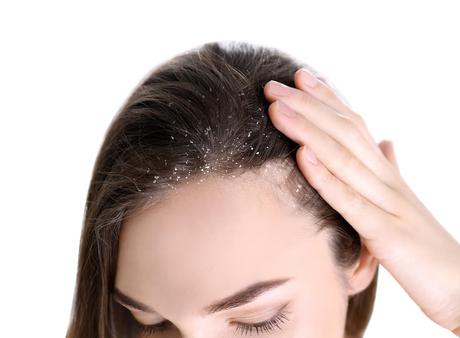 Lice Eggs vs. Dandruff: What’s Causing Your Scalp Issues? danduff