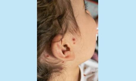 Lump Behind Ear: Causes, Treatment, Prevention