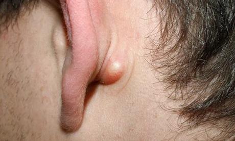 Lump Behind Ear: Causes, Treatment, Prevention