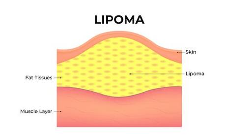 Lump Behind Ear: Causes, Treatment, Prevention