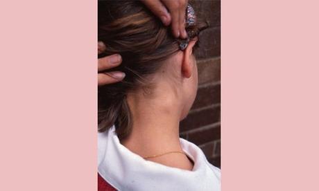 Lump Behind Ear: Causes, Treatment, Prevention