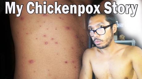 chickenpox story, varicella zoster, living alone with chickenpox, healing process from chickenpox, adult chickenpox experience, chickenpox recovery tips, chickenpox symptoms, dealing with chickenpox alone, middle class life in the city, working class health challenges, chickenpox in adults, chickenpox healing journey, managing chickenpox while living alone, personal health stories, chickenpox treatment, self-care during chickenpox, life in the city with chickenpox, chickenpox struggles, 14-day chickenpox recovery, overcoming chickenpox