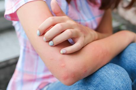 Picture of person in need to mosquito control in Baton Rouge, La. Arm with a lot of mosquito bites.