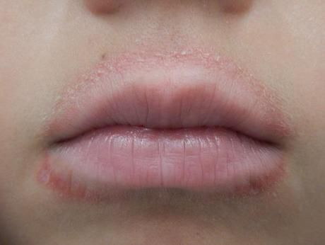 Ten Of The Best Home Remedies for Chapped Lips Ten Of The Best Home Remedies for Chapped Lips
