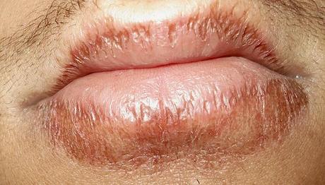 Ten Of The Best Home Remedies for Chapped Lips Ten Of The Best Home Remedies for Chapped Lips