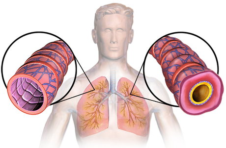 Asthma in Children – Symptoms and Treatment Here's everything you need to know about asthma in children - signs, causes, diagnosis, treatment and ways to prevent attacks in the future.