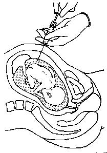 Can Paternity Testing Be Done With a Simple Maternal Blood Test?