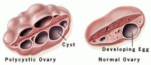 Polycystic Ovary