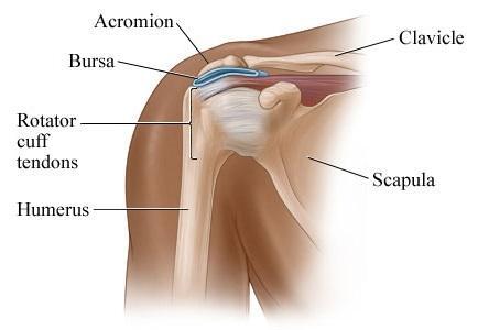 bursitis