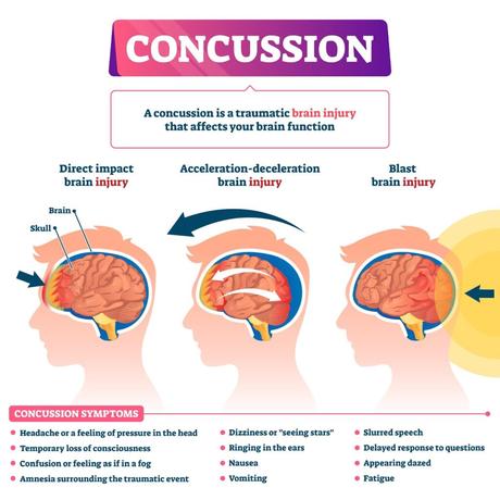 How Long Does Post-Concussion Syndrome Last? – Key Factors