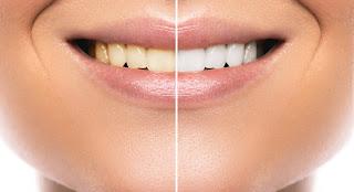 What Affects Teeth Whitening Cost in Singapore? Key Factors Explained