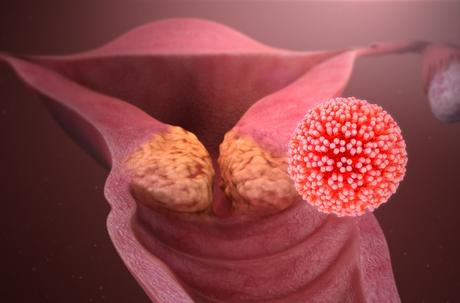 There's a lot of chatter about the HPV vaccine for kids, leaving parents confused and worried. Read on to find the answers to all your questions.