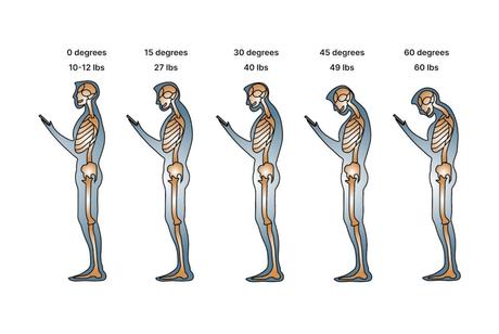 Cervical Lordosis