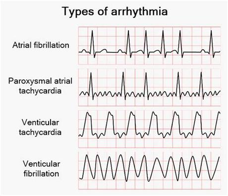 During What Period Of Time Could A Stimulus To The Heart Cause A Life-Threatening Arrhythmia?