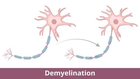 Understanding Trigeminal Nerve Pain and Why It Happens