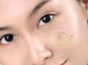 Effective Ways Remove Scars Naturally
