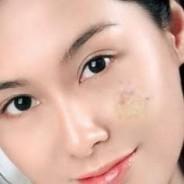 Effective Ways To Remove Scars Naturally