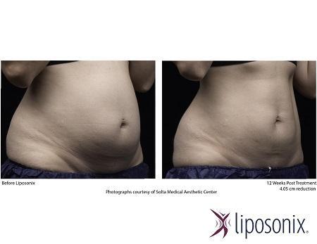 Liposonix reducing fat without surgery in Hong Kong