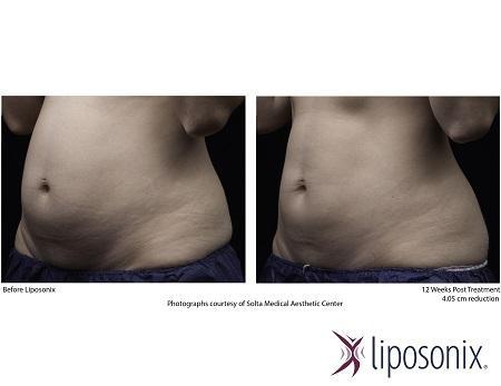 Liposonix reducing fat without surgery in Hong Kong