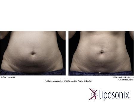 Liposonix reducing fat without surgery in Hong Kong