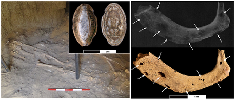 The Egyptian skeleton (left) and some of the lesions on a rib (right)