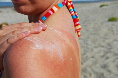 Tips to stay away from Sun Burns