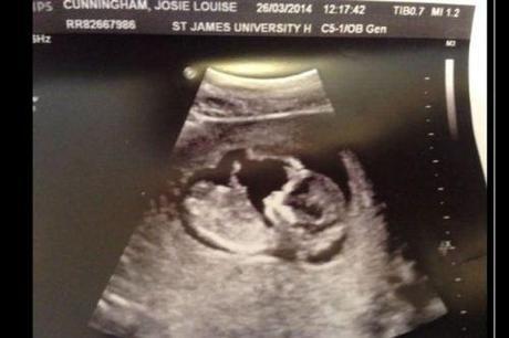 Josie-Cunningham-pregnancy-scan-3434068