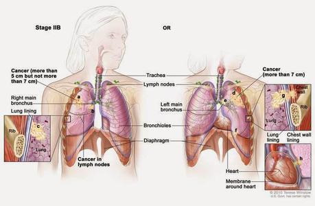 Stage IV Lung Cancer
