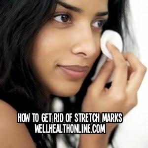 How to get rid of stretch marks