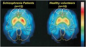 brain with schizoprenia