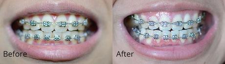 Smile Brilliant - Professional Teeth Whitening - Genzel Kisses (C) Photo (8)