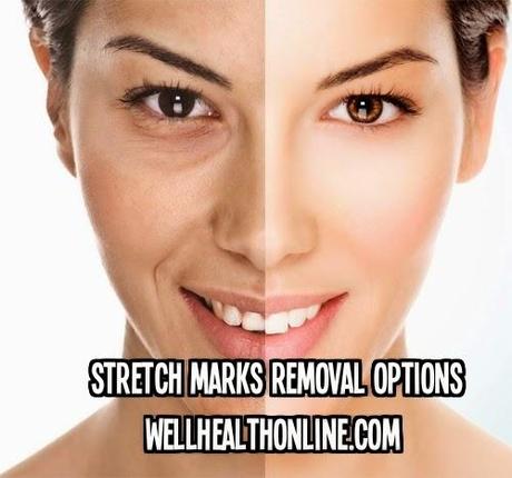Stretch Marks Removal Options You Should Know About