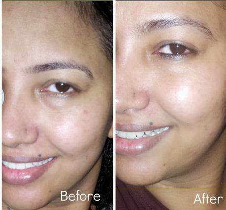 Before and After - Review of Lakme  Perfect Radiance Polishing Serum and Intense Whitening Light Creme