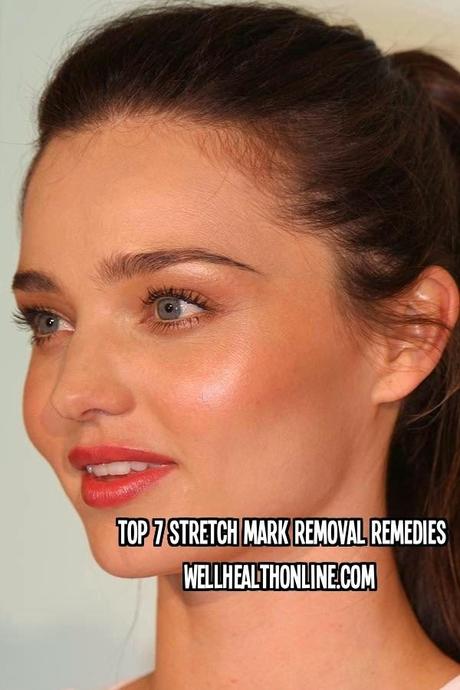 How to Remove Stretch Marks - Top 7 Stretch Mark Removal Remedies