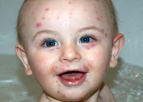 Chickenpox lollipops rehash debate over vaccines