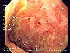 Endoscopic image of ulcerative colitis affecti...