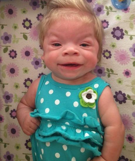A Little Girl With Williams Syndrome
