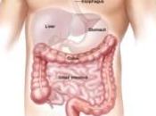 Natural Treatment Prevent Colon Cancer