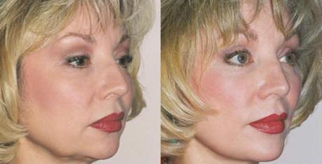 Cheek Augmentation - Before & After Cheek Augmentation - Before & After