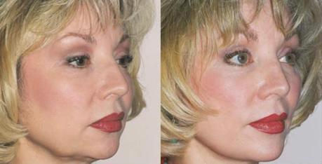 Cheek Augmentation - Before & After