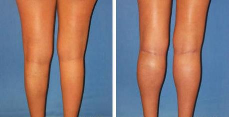  Calf Implants or Calf Augmentation Surgery - Before & After